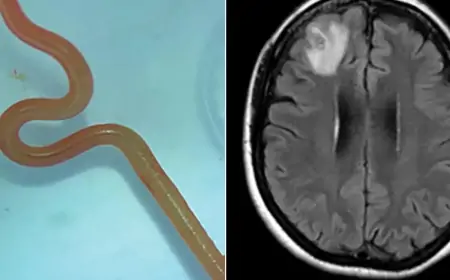 பெண்ணின் மூளையில் உயிருடன் இருந்த புழு! வைத்தியர்கள் அதிர்ச்சி!