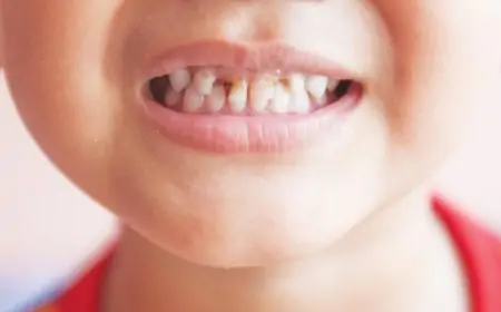  96வீத சிறுவர்கள் பல் நோயால் பாதிப்பு - விடுக்கப்பட்டுள்ள அறிவுறுத்தல்