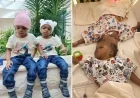 AI தொழில்நுட்ப உதவியுடன் இணைந்த இரட்டையர்கள் வெற்றிகரமாகப் பிரிப்பு: மருத்துவ உலகில் புதிய சாதனை